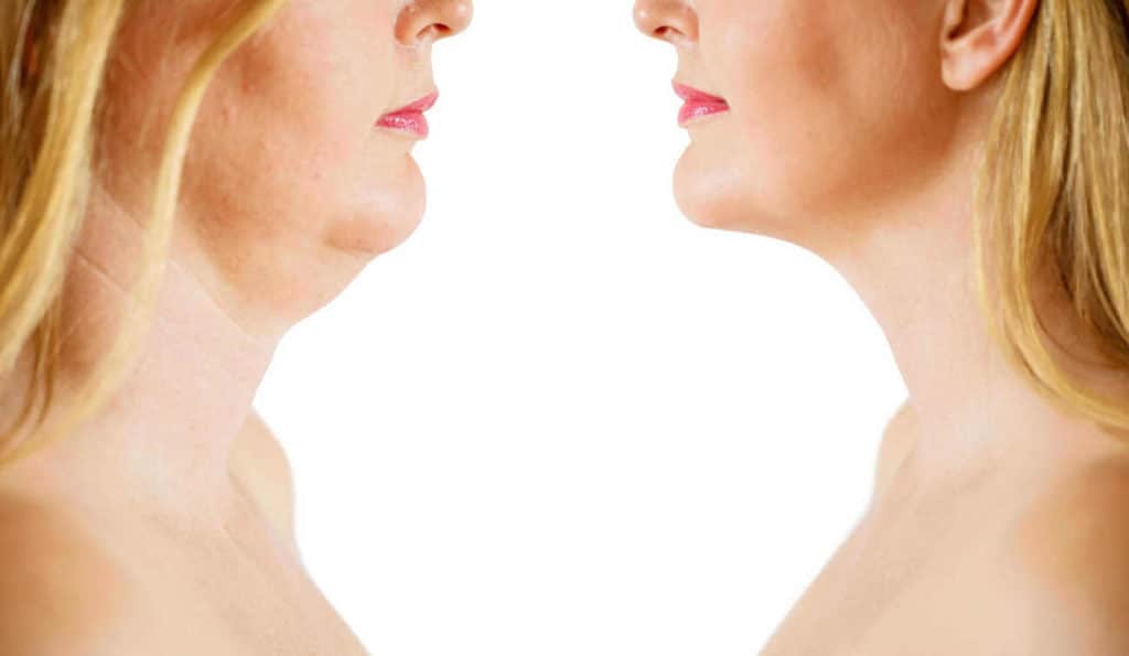 Double Chin treatment Wokingham before and after results