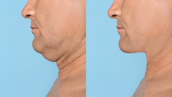 Which Non-Surgical Treatments Work Best for Jowls and Loose Skin Wokingham?