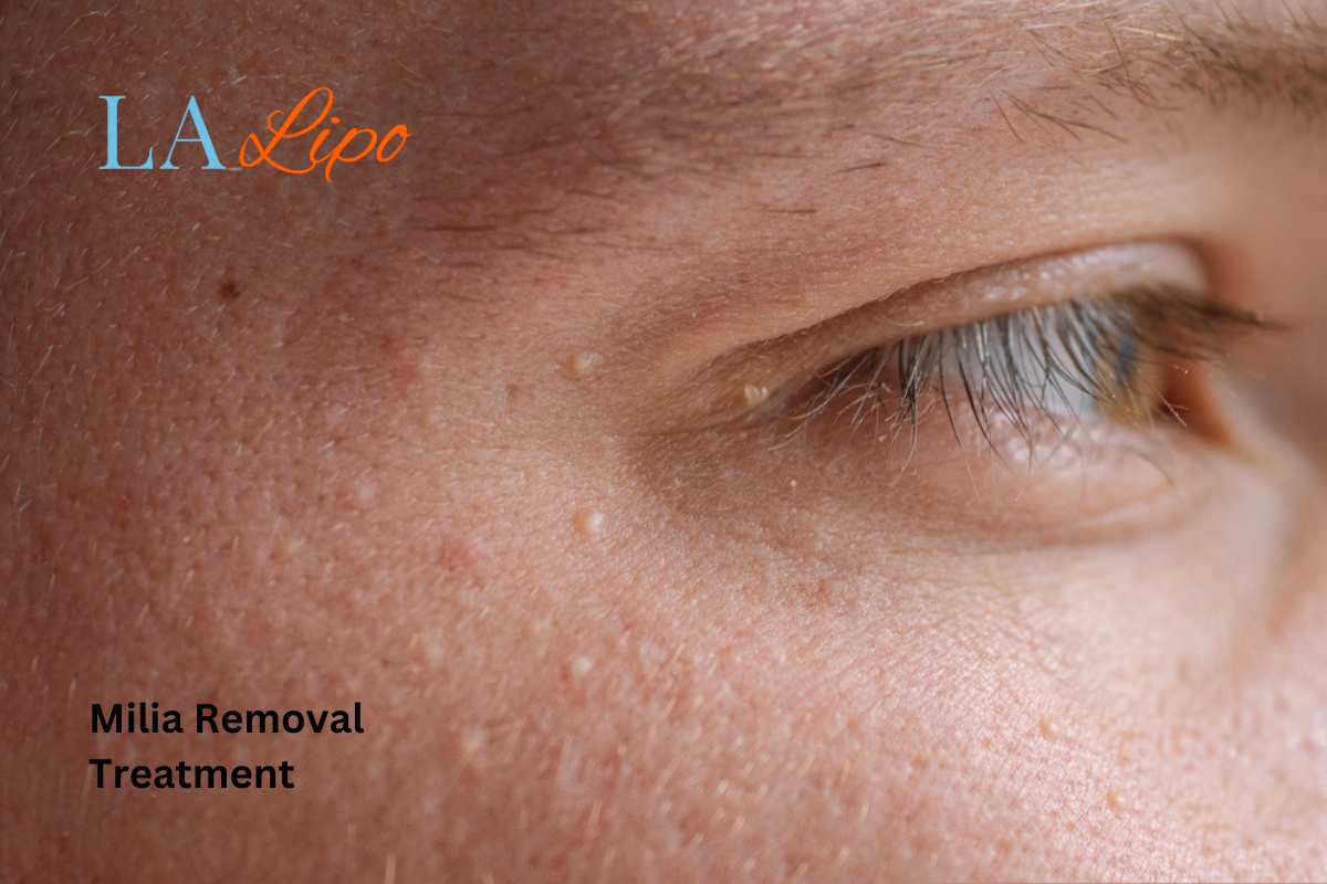 Cryopen Milia Removal: Is It the Easiest and Safest Option Wokingham?