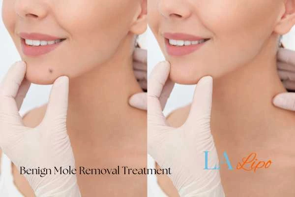 woman's before and after mole removal Wokingham results