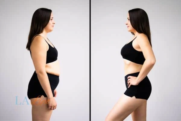 image of woman before and after results of LA-EMS Body Sculpting Wokingham to help treat Diastasis recti