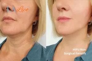 hi-fu for wrinkles Wokingham before and after results