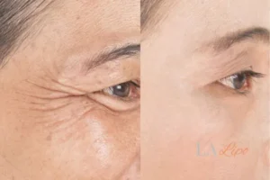 Before and after results of woman - HI-fu wrinkles reduction treatment Wokingham