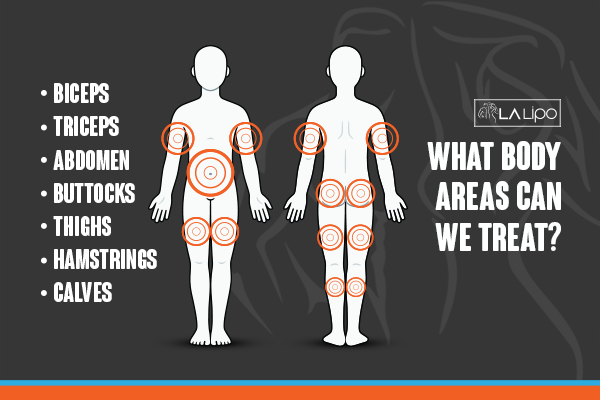 Graphic to show areas you can have LA-EMS Body Sculpting Wokingham treatment.