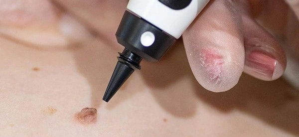 skin tag removal using cryopen Wokingham