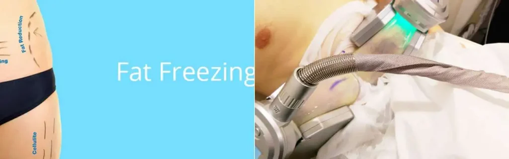 Fat freezing Wokingham on multiple areas of the body