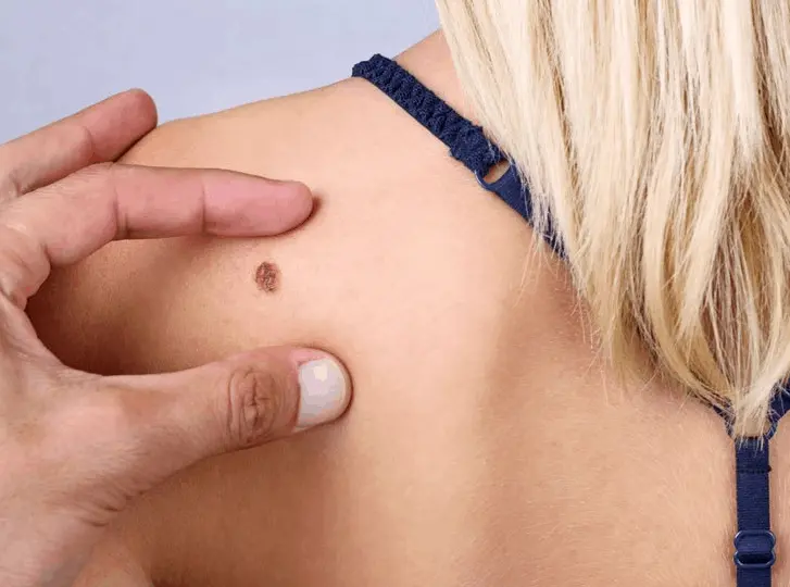 woman having mole removal Wokingham consultation before treatment.