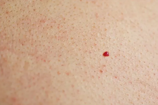 close up of a cherry angioma Wokingham