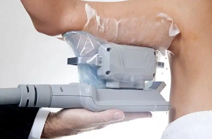Picture of fat freezing Wokingham on the upper arms.