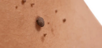 image of a skin tag Wokingham