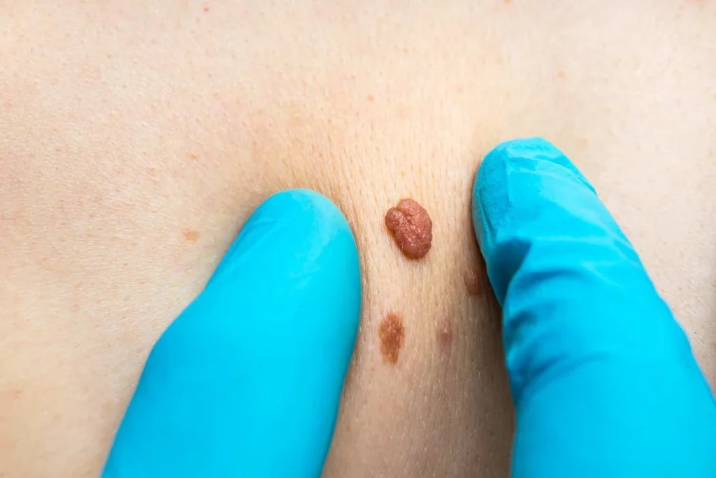 Consultant examining a skin tag Wokingham