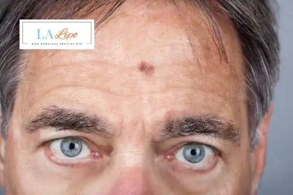 Solar Lentigo Removal Wokingham image of man with mark on his forehead