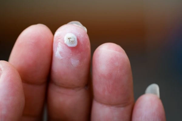 wart on person finger - cryotherapy to treat from LA LIPO Wokingham