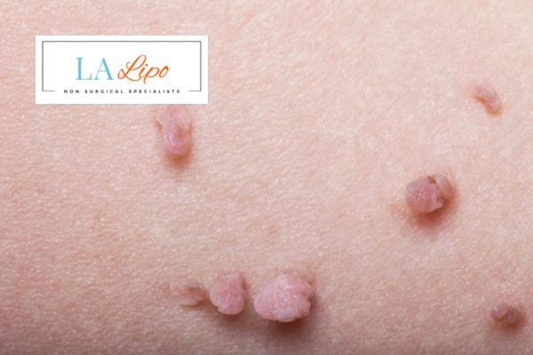 Does cryopen skin tag removal Wokingham hurt? Find out now call our team today!