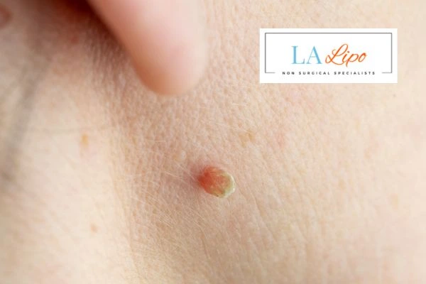 Book skin tag removal Wokingham today speak to our team now!