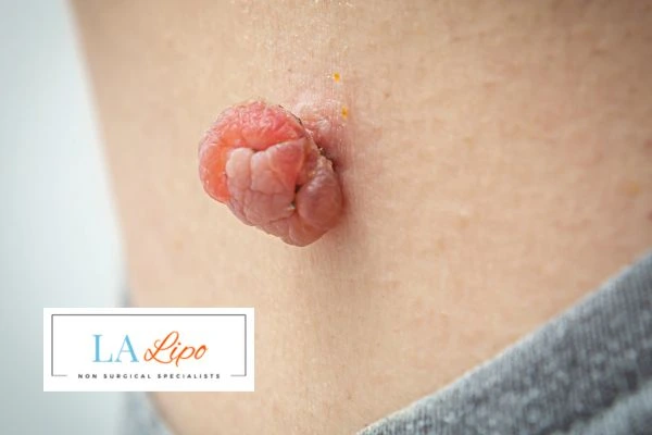Interested in skin tag removal Wokingham? Concerned about the pain? Find out more today!