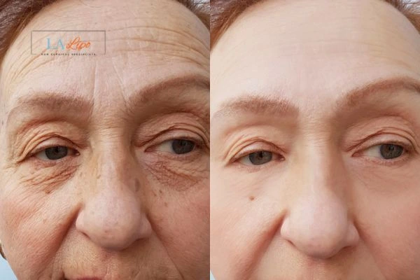 The powerful benefits of Morpheus8 Treatment Wokingham - Call Our team today!