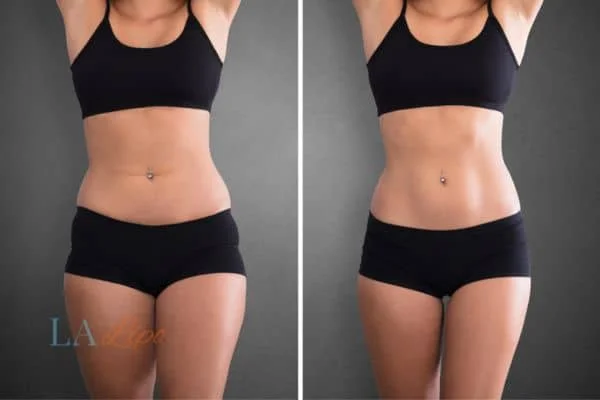 before and after results of non-surgical treatment to help a woman's body image and mental health Wokingham