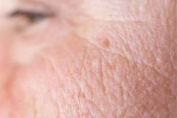 close up picture of a woman's face showing an age spot Wokingham