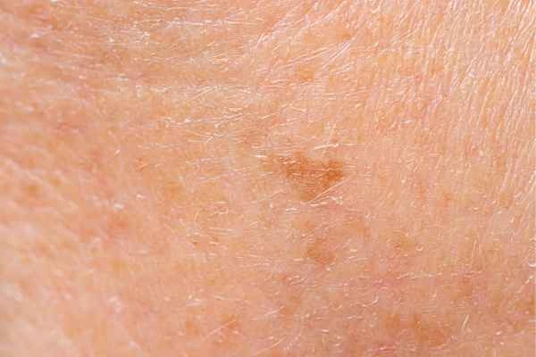 close up picture of age spots Wokingham
