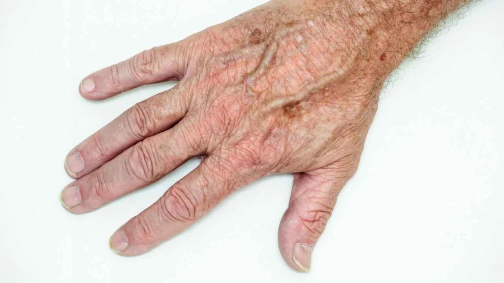 Male hand showing age spot Wokingham