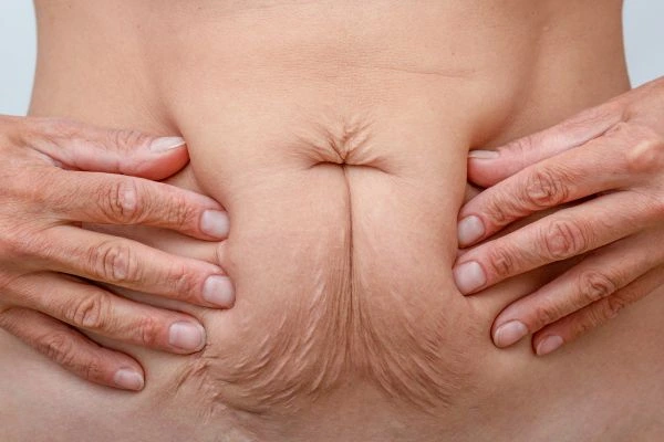 Should I Combine Diastasis Recti Treatment with Body Contouring for Better Results Wokingham?