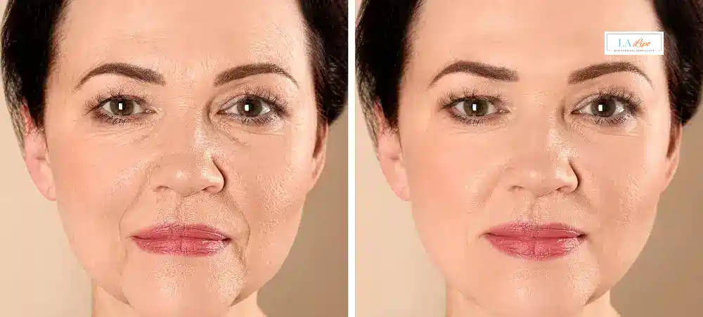 How Long Does It Take to See Results and How Long Do They Last Wokingham?
