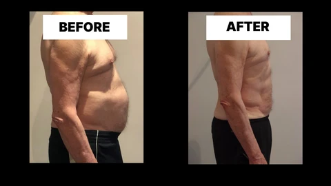 What Symptoms Can Diastasis Recti Cause in Men? Weak Core, Back Pain and Poor Posture Wokingham
